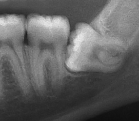 Wisdom tooth X-Ray